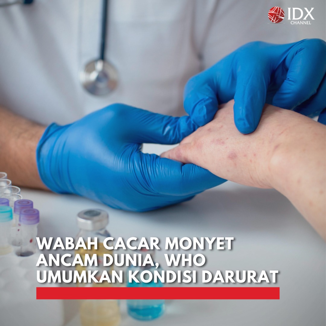 WHO Umumkan Wabah Cacar Monyet Sebagai Keadaan Darurat